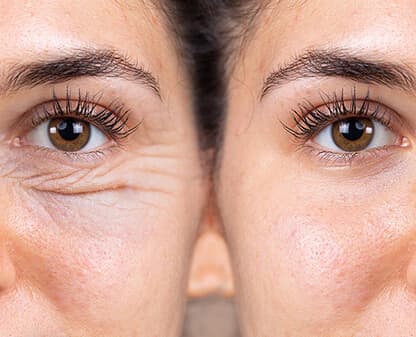 Blefaroplastía (cirugía de párpados)